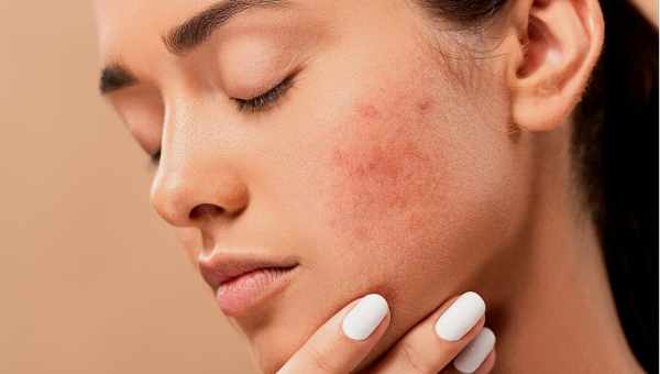 5 распространенных проблем кожи. Вредные советы